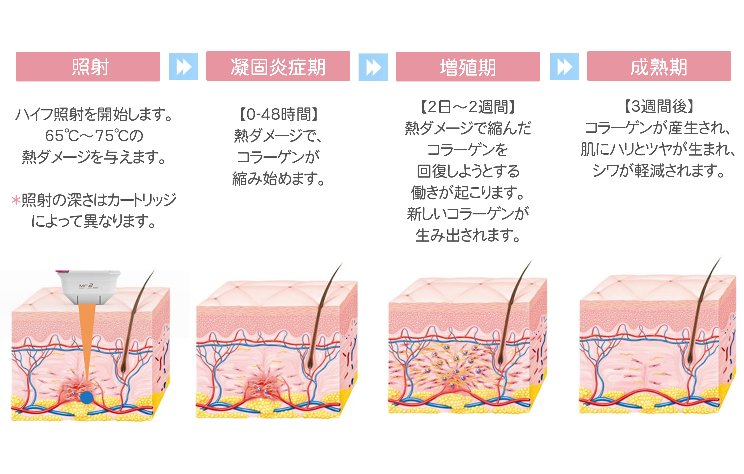 ハイフ治療の経過