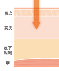 レーザー（CO2）