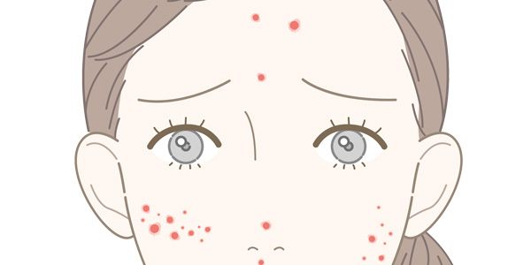 ニキビ